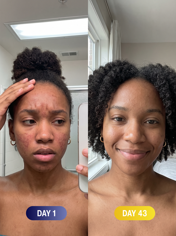 My face stopped feeling raw